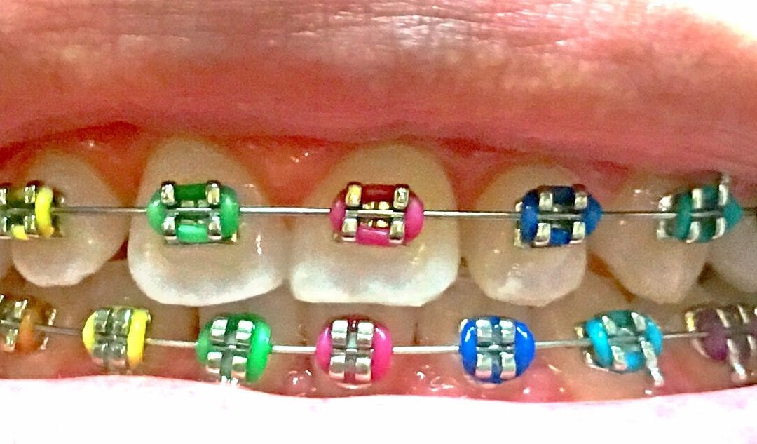 How to Help Your Teen Take Care of Braces