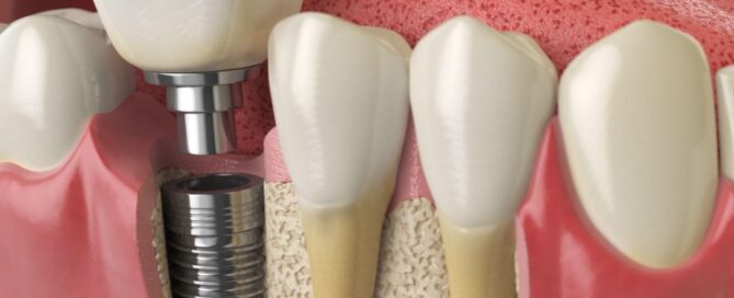 dental implant in molar graphic