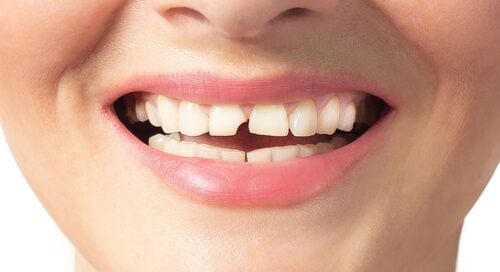 Chipped Tooth on Women Smile