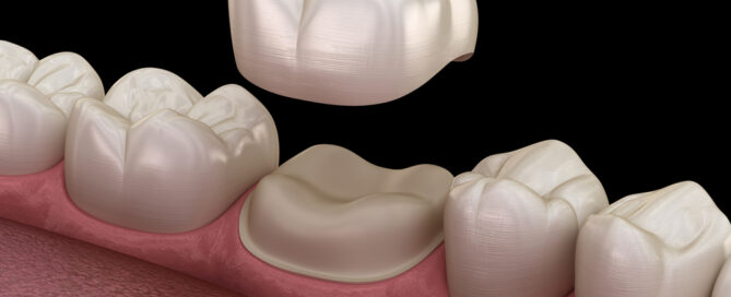 dental crowns and bridges