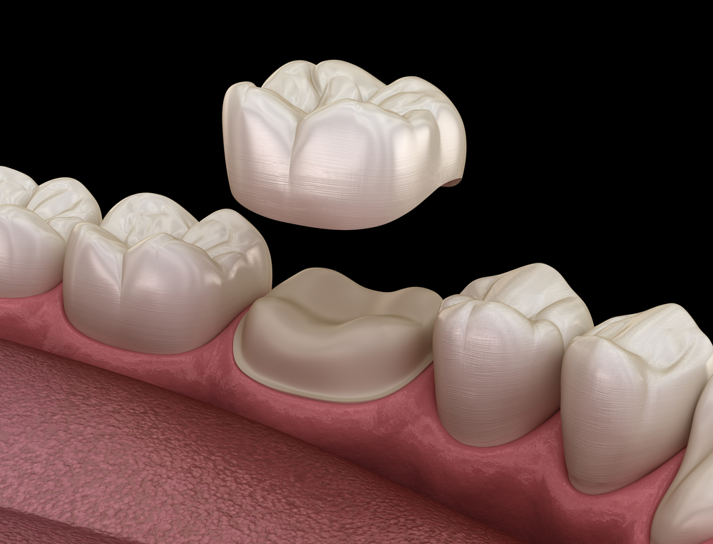 dental crowns and bridges
