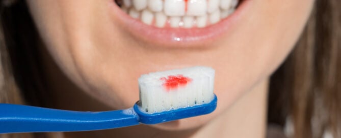 Bleeding gums