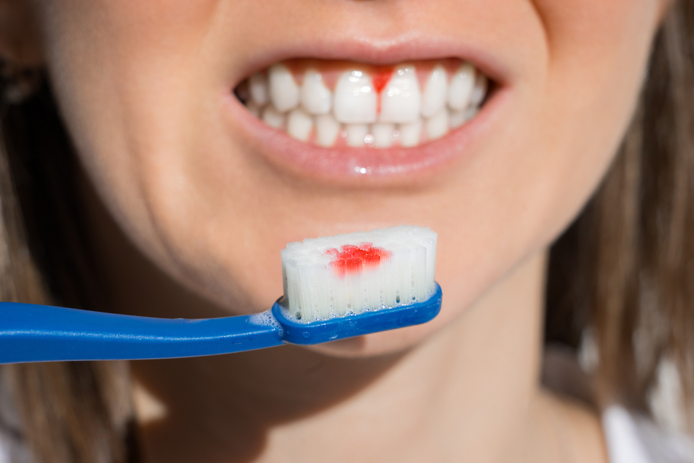 Bleeding gums