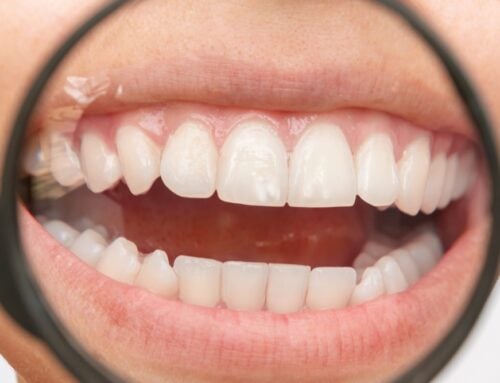 Can Tooth Decay Be Reversed? What You Need to Know