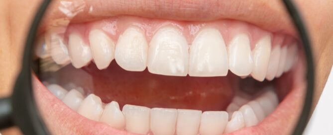 can tooth decay be reversed - image of a woman with white spots on her teeth.