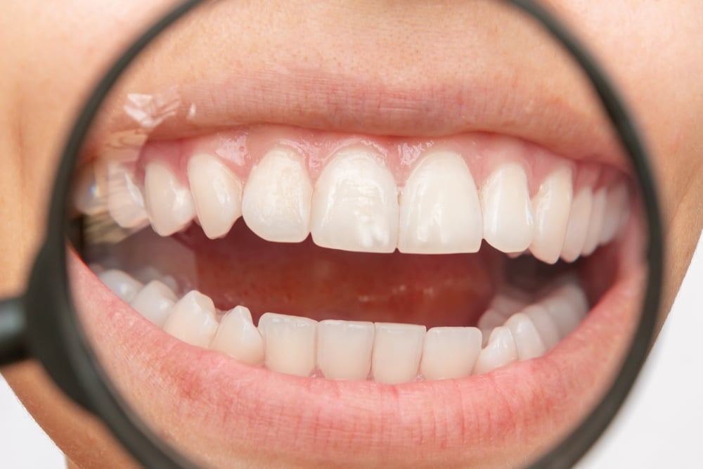 can tooth decay be reversed - image of a woman with white spots on her teeth.
