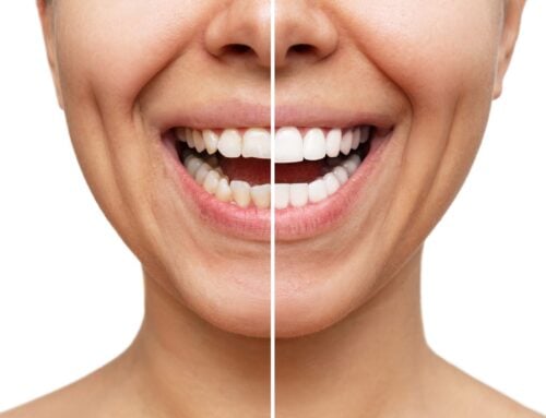 Dental Bonding vs Veneers: Which Is Right for You?